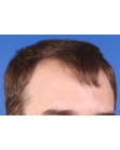 Before Hair Transplant&nbsp;Hairlines